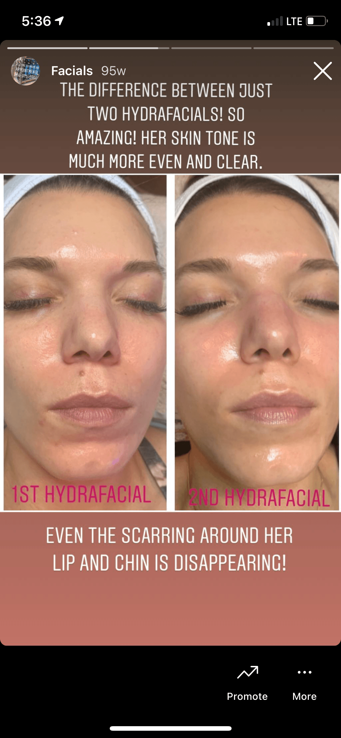 Real client Instagram story screenshot showing 1st HydraFacial vs 2nd HydraFacial progression at Lovely Lilly's North Austin studio — client's own captions describe scarring around the lip and chin disappearing