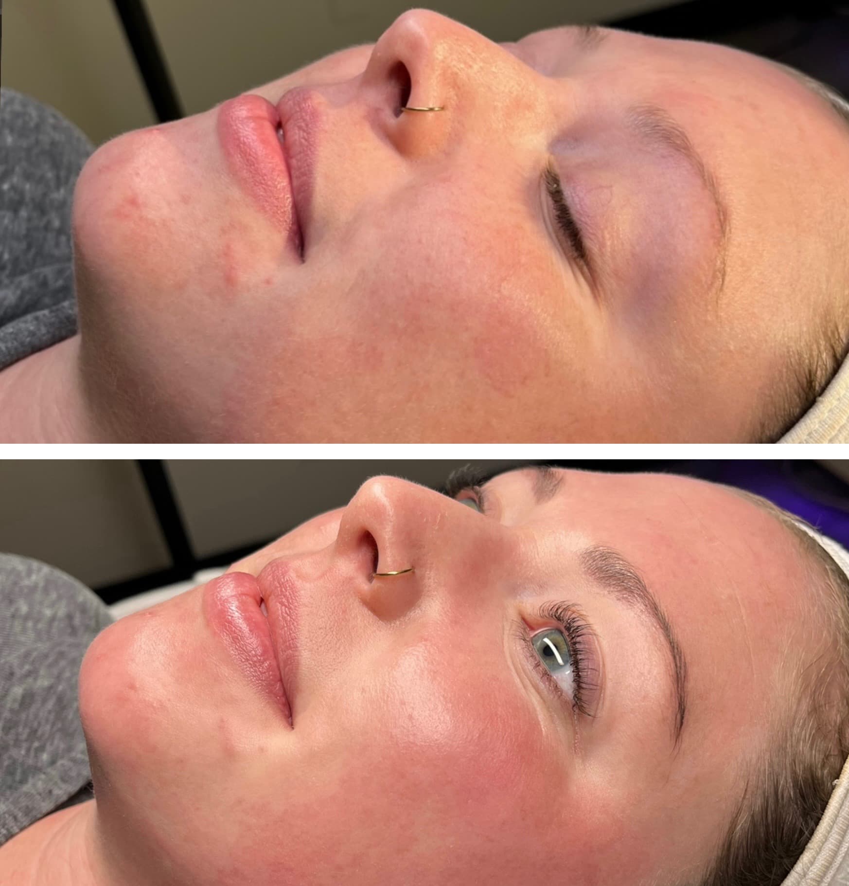 Real client showing skin texture and tone improvement after 1 HydraFacial session at Lovely Lilly's North Austin studio