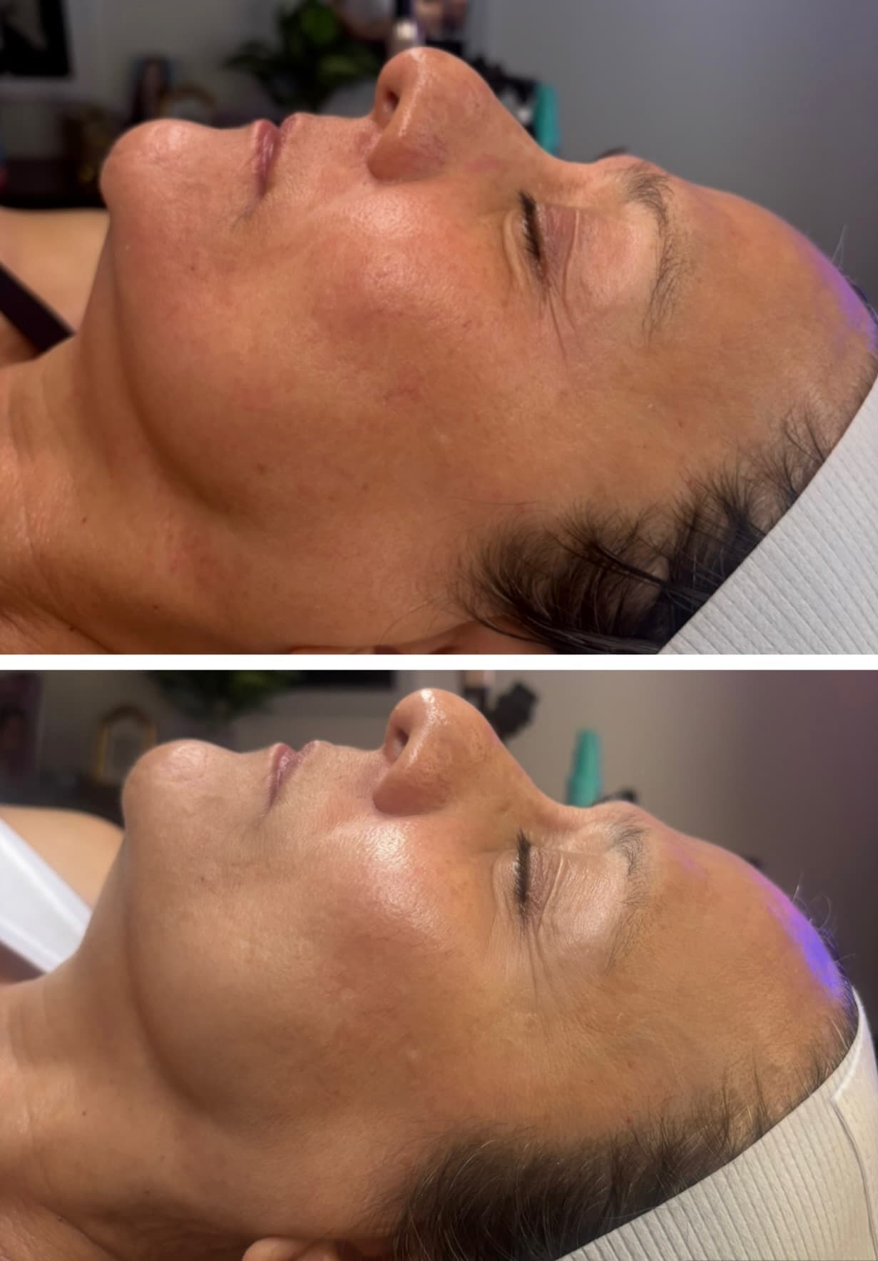 Real client showing tone and glow improvement after a 2-treatment Procell Microchanneling series at Lovely Lilly's North Austin studio