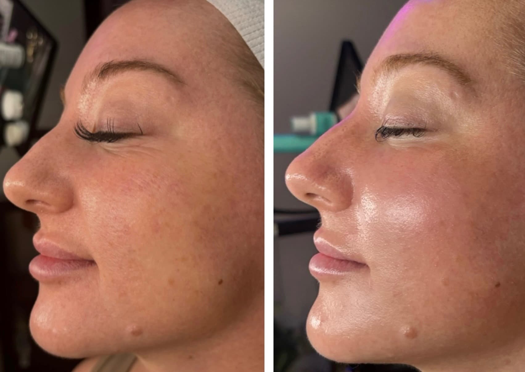Real client showing acne transformation after a 3-treatment Procell Microchanneling series at Lovely Lilly's North Austin studio