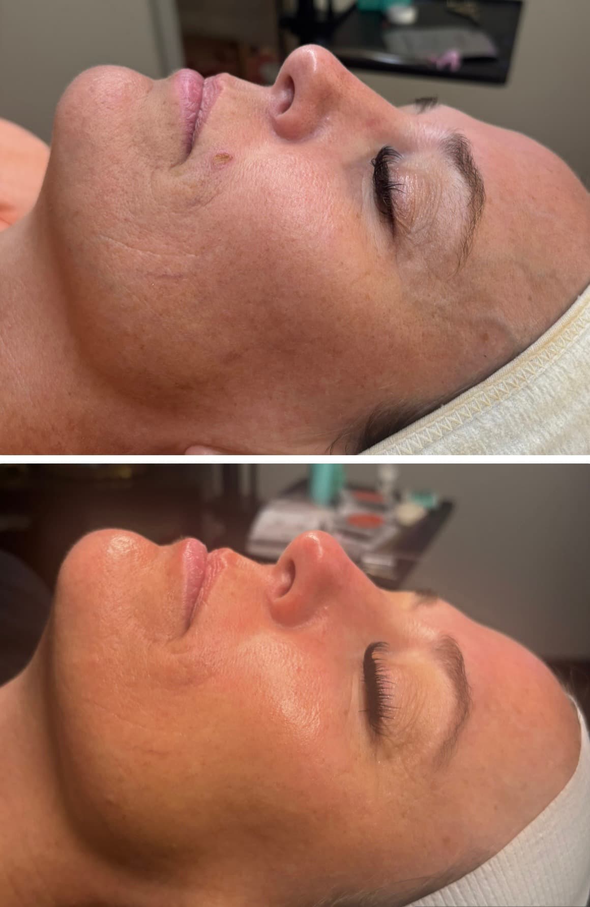 Real client showing improved skin texture and tone after 3 Procell Microchanneling treatments at Lovely Lilly's