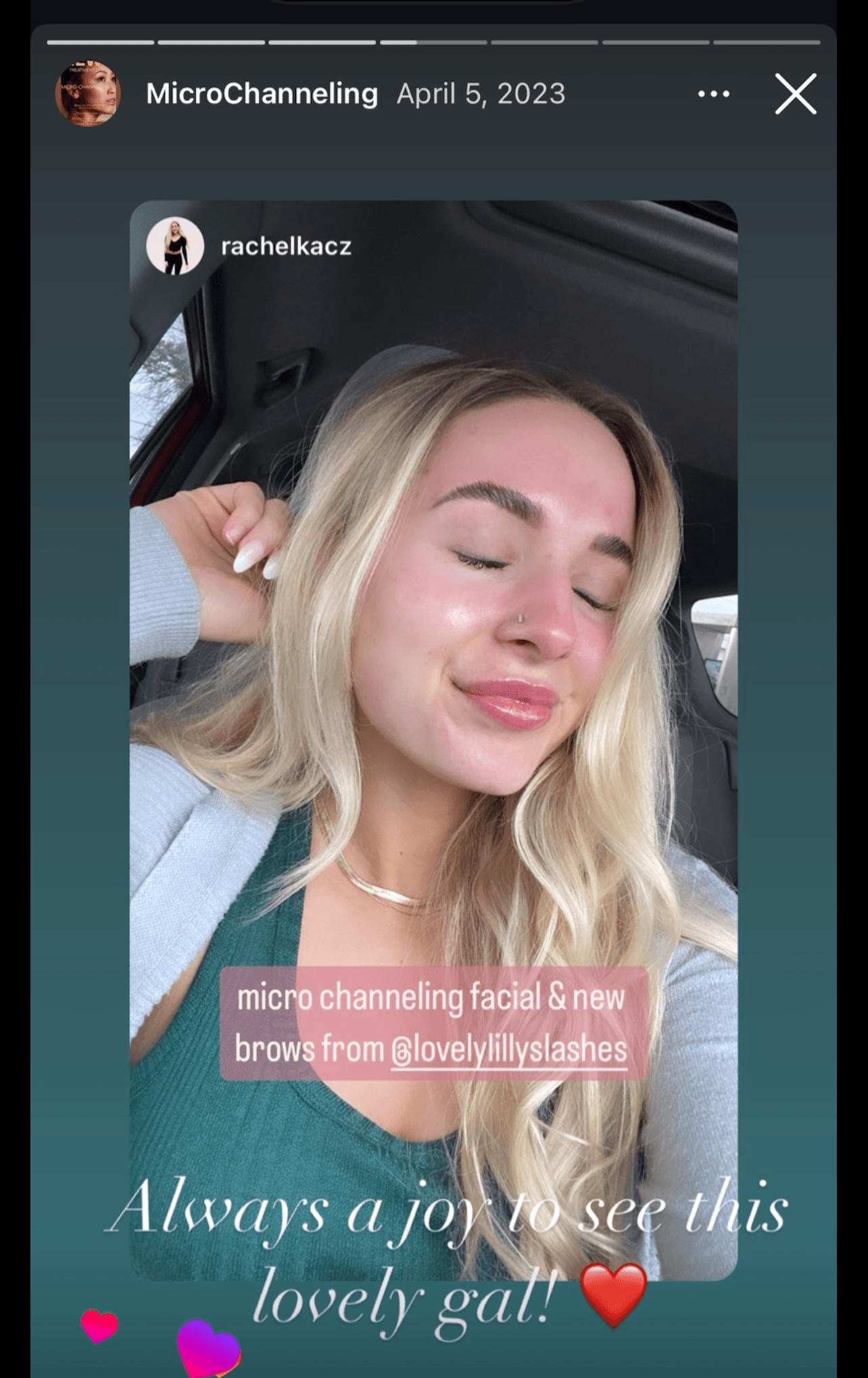 Rachel K. after microchanneling and brows